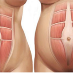 Diastasi Addominale e Intervento Chirurgico