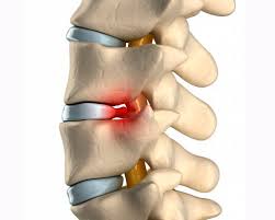 Ernia cervicale, cosa fare cure e rimedi - Fisioterapia Roma: MEDBEN