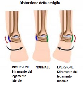 distorsione caviglia