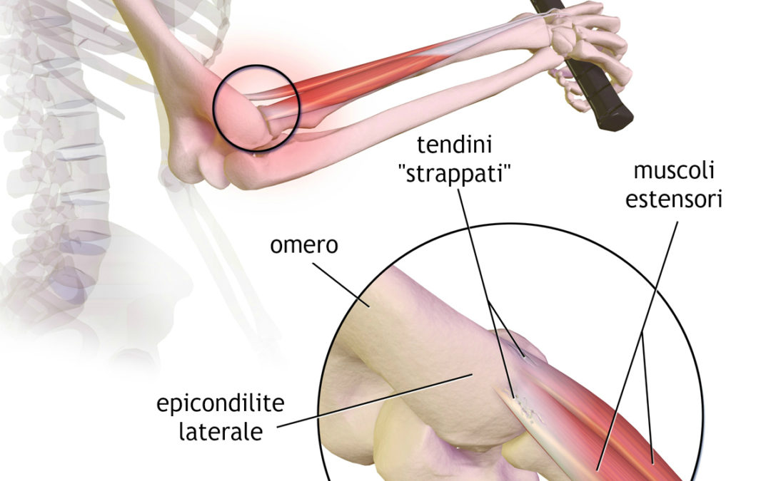 Epicondilite: come curarla velocemente con fisioterapia balduina