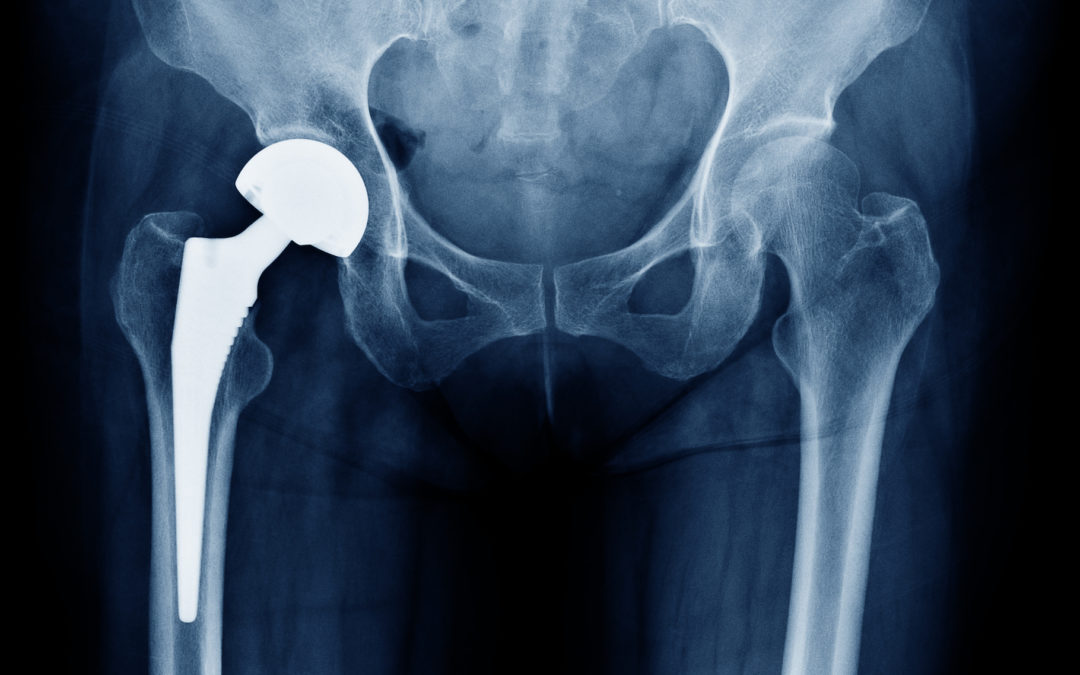 Protesi d’anca: riabilitazione