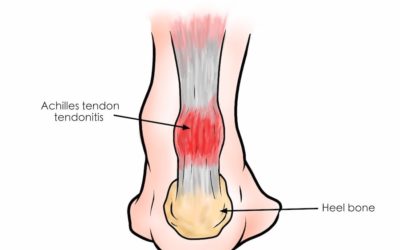 Infiammazione del tendine d’Achille: come si cura