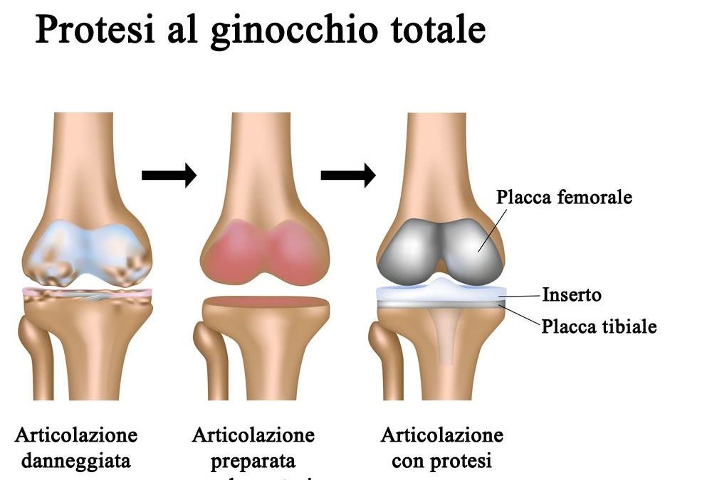 Protesi di ginocchio: quali esercizi fare a casa