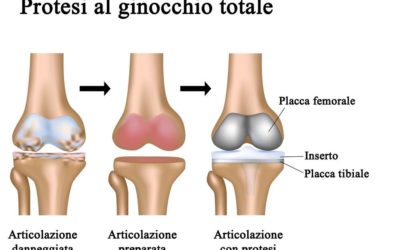 Protesi di ginocchio: quali esercizi fare a casa