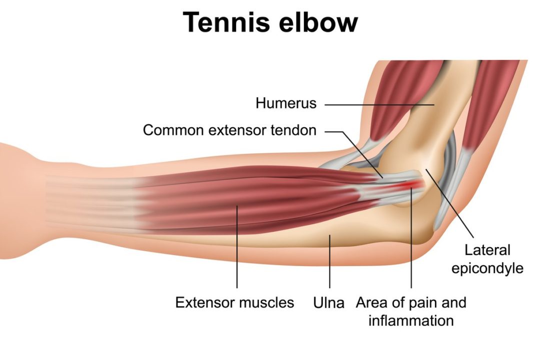 EPICONDILITE: anatomia, diagnosi e cura